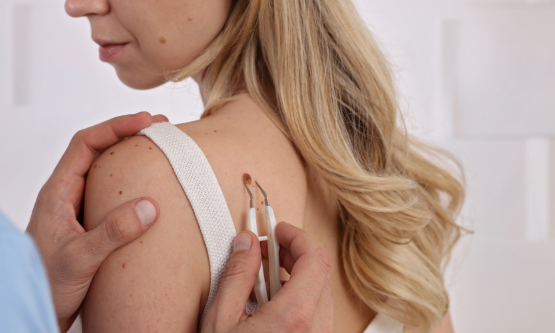 Skin Tag